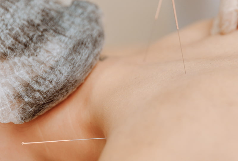 Frau wird mit Akupunktur-Nadeln im Schulterbereich behandelt